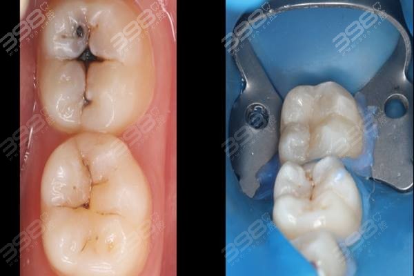 补牙几个月后牙疼，原因、对策与预防